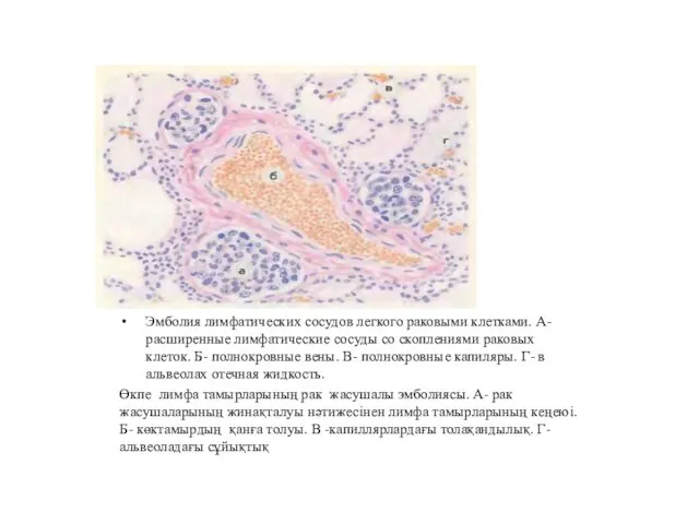 Эмболия лимфатических сосудов легкого раковыми клетками. А- расширенные лимфатические сосуды