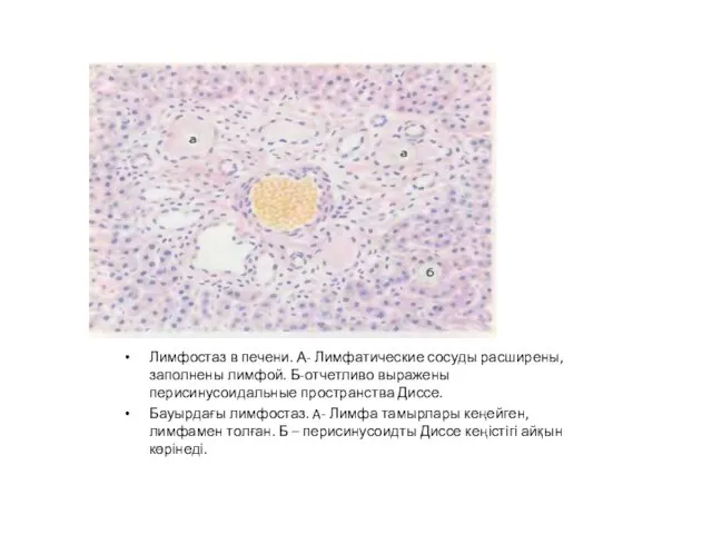 Лимфостаз в печени. А- Лимфатические сосуды расширены, заполнены лимфой. Б-отчетливо