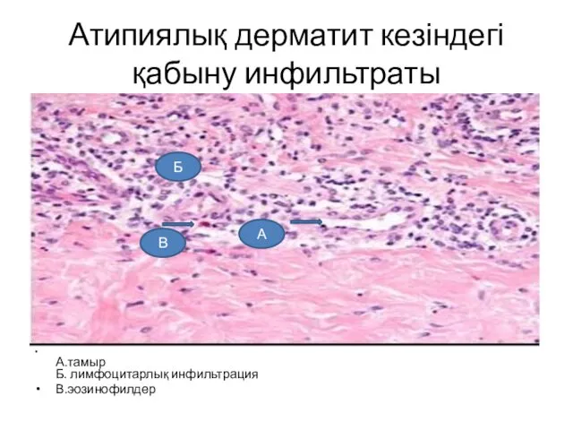 Атипиялық дерматит кезіндегі қабыну инфильтраты А.тамыр Б. лимфоцитарлық инфильтрация В.эозинофилдер В Б А