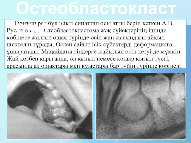 Тұңғыш рет бұл ісікті сипаттап осы атты беріп кеткен А.В.Русаков