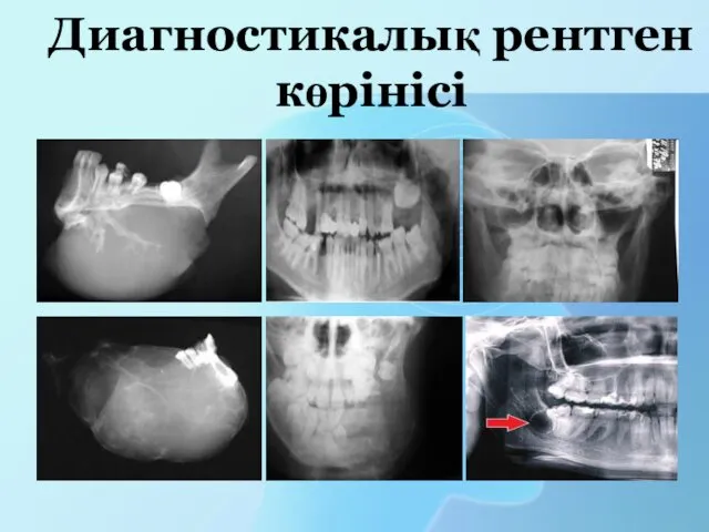 Диагностикалық рентген көрінісі