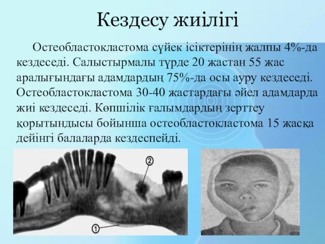 Кездесу жиілігі Остеобластокластома сүйек ісіктерінің жалпы 4%-да кездеседі. Салыстырмалы түрде