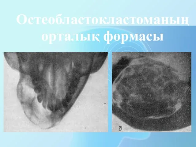 Остеобластокластоманың орталық формасы