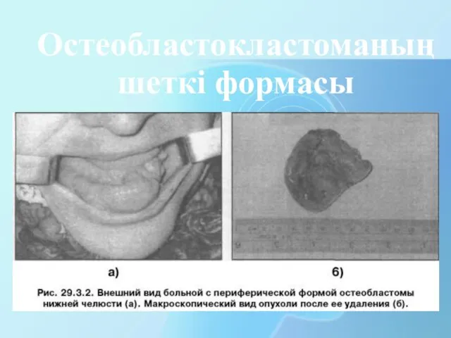 Остеобластокластоманың шеткі формасы