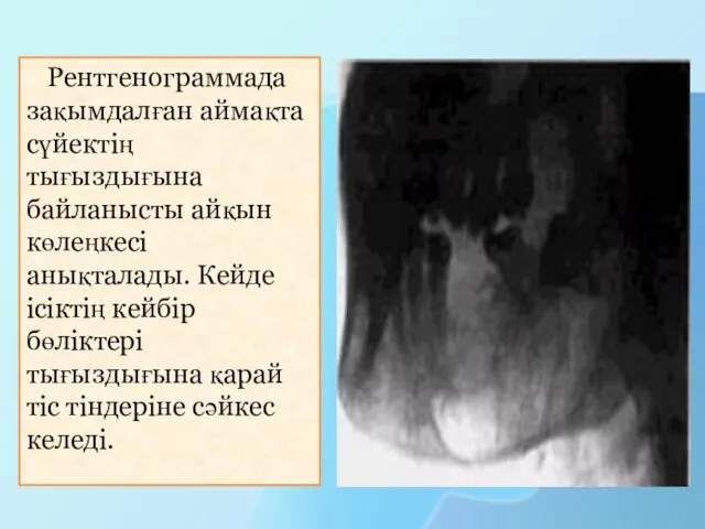 Рентгенограммада зақымдалған аймақта сүйектің тығыздығына байланысты айқын көлеңкесі анықталады. Кейде