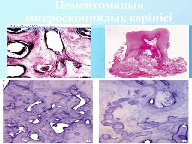 Цементоманың микроскопиялық көрінісі