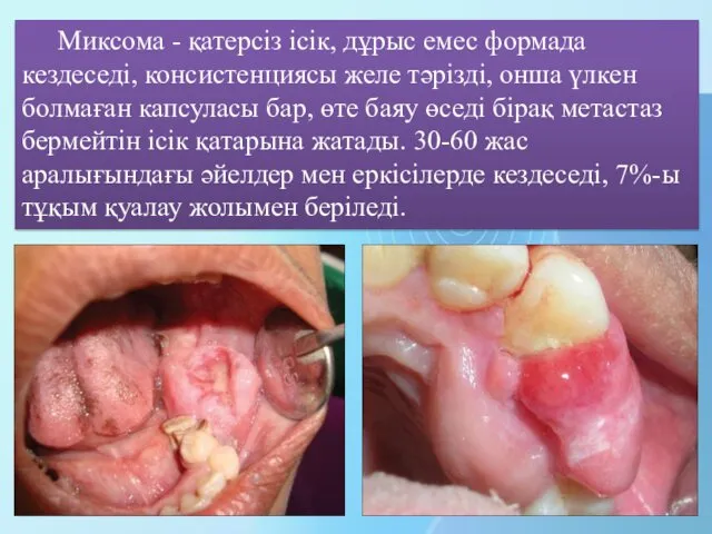 Миксома - қатерсіз ісік, дұрыс емес формада кездеседі, консистенциясы желе