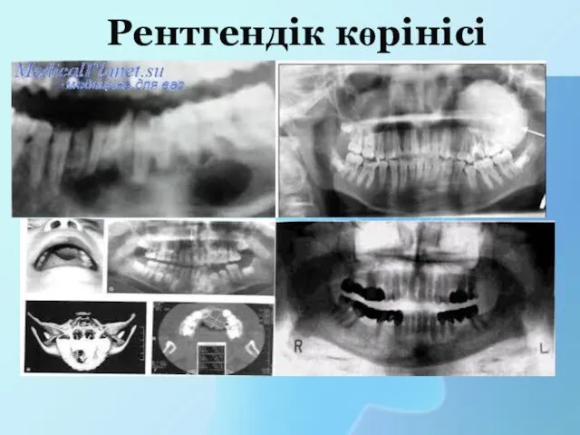 Рентгендік көрінісі