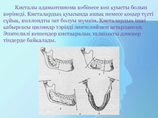 Кисталы адамантинома көбінесе көп қуысты болып көрінеді. Кисталардың қуысында ашық