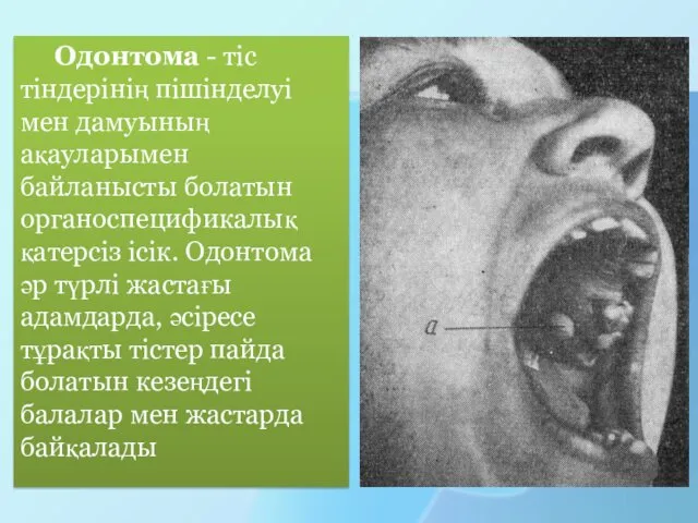 Одонтома - тіс тіндерінің пішінделуі мен дамуының ақауларымен байланысты болатын