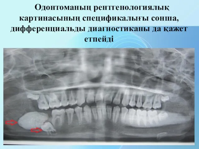 Одонтоманың рентгенологиялық картинасының спецификалығы сонша, дифференциальды диагностиканы да қажет етпейді