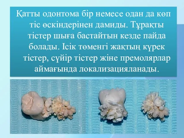 Қатты одонтома бір немесе одан да көп тіс өскіндерінен дамиды.