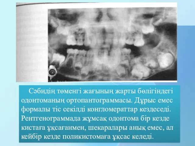 Сәбидің төменгі жағының жарты бөлігіндегі одонтоманың ортопантограммасы. Дұрыс емес формалы