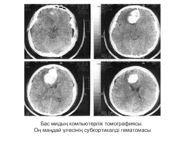 Бас мидың компьютерлік томографиясы. Оң маңдай үлесінің субкортикалді гематомасы