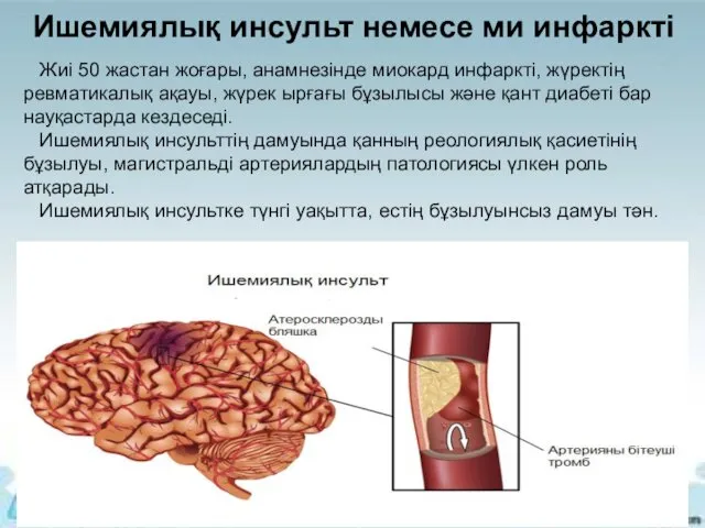 Жиі 50 жастан жоғары, анамнезінде миокард инфаркті, жүректің ревматикалық ақауы, жүрек ырғағы бұзылысы