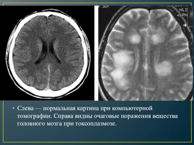 Слева — нормальная картина при компьютерной томографии. Справа видны очаговые поражения вещества головного мозга при токсоплазмозе.