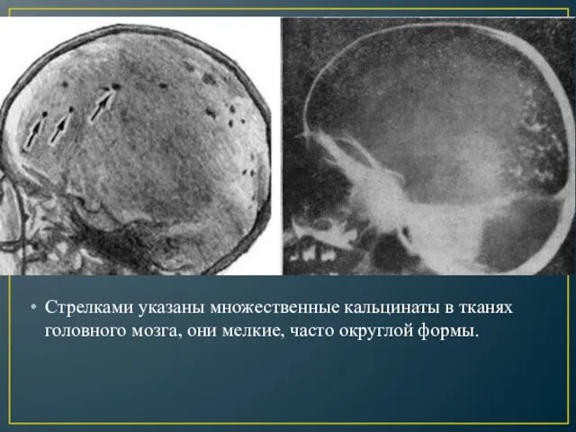 Стрелками указаны множественные кальцинаты в тканях головного мозга, они мелкие, часто округлой формы.