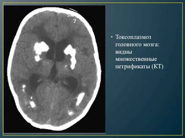 Токсоплазмоз головного мозга: видны множественные петрификаты (КТ)