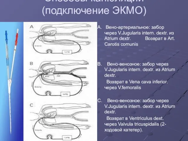 Способы канюляции (подключение ЭКМО) А. Вено-артериальное: забор через V.Jugularis intern.