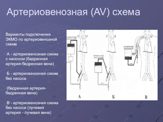 Артериовенозная (AV) схема Варианты подключения ЭКМО по артериовенозной схеме А