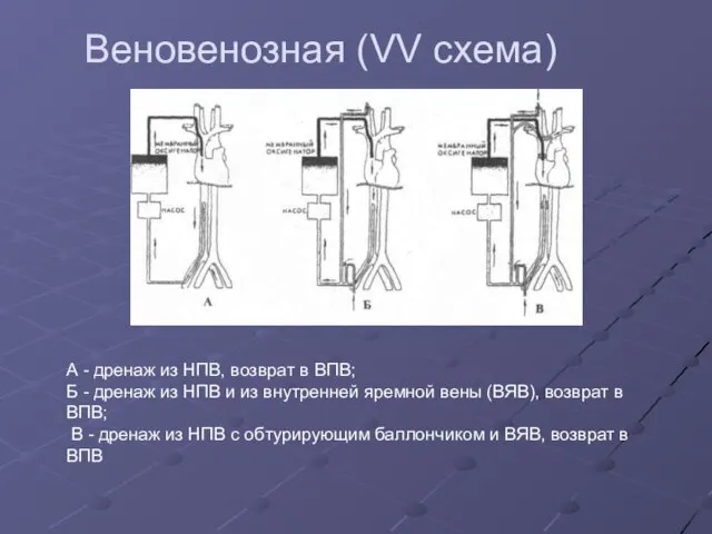 Веновенозная (VV схема) А - дренаж из НПВ, возврат в