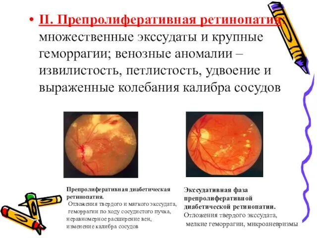 II. Препролиферативная ретинопатия: множественные экссудаты и крупные геморрагии; венозные аномалии