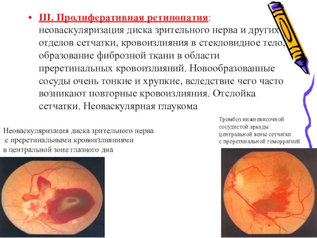 III. Пролиферативная ретинопатия: неоваскуляризация диска зрительного нерва и других отделов