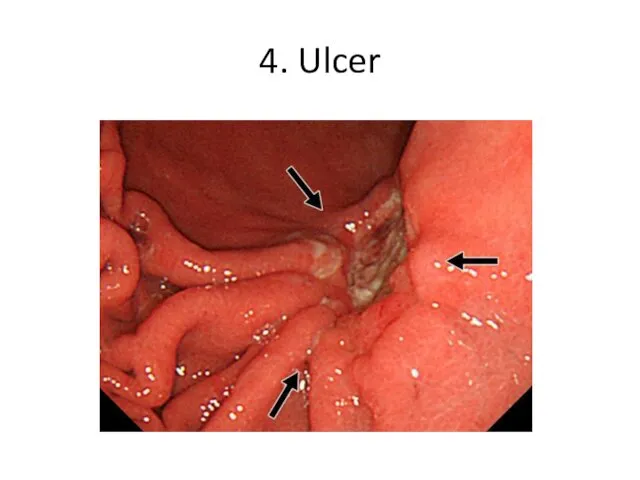 4. Ulcer