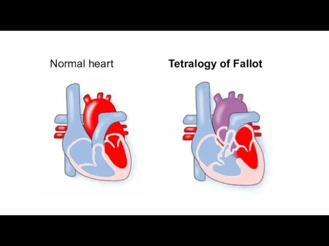 Normal heart Tetralogy of Fallot