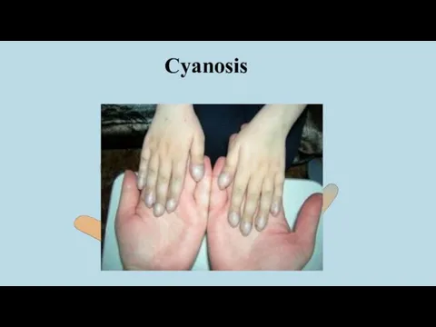 Cyanosis