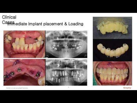 Immediate implant placement & Loading Clinical Cases