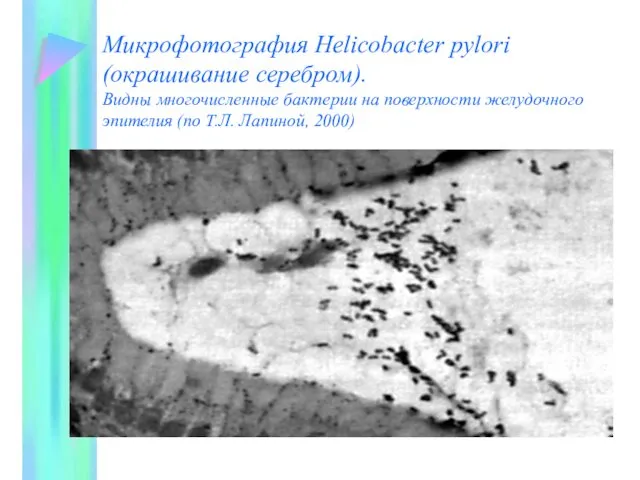 Микрофотография Helicobacter pylori (окрашивание серебром). Видны многочисленные бактерии на поверхности желудочного эпителия (по Т.Л. Лапиной, 2000)
