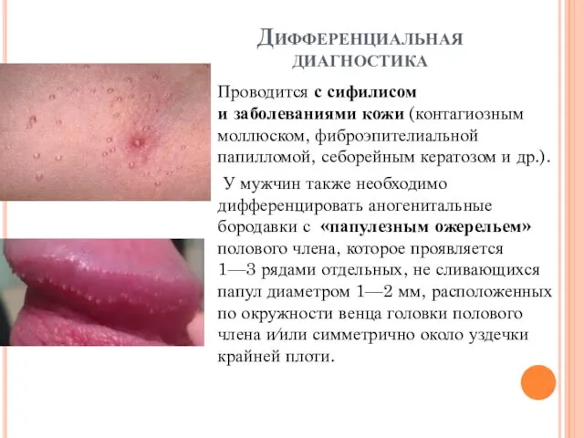 Дифференциальная диагностика Проводится с сифилисом и заболеваниями кожи (контагиозным моллюском, фиброэпителиальной папилломой, себорейным
