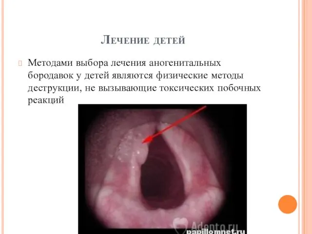 Лечение детей Методами выбора лечения аногенитальных бородавок у детей являются физические методы деструкции,