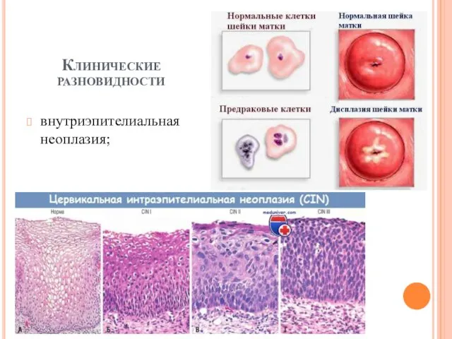 внутриэпителиальная неоплазия; Клинические разновидности