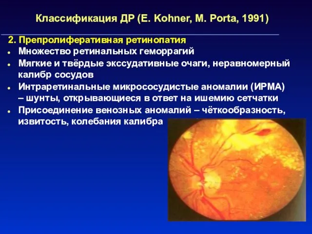 Классификация ДР (E. Kohner, M. Porta, 1991) 2. Препролиферативная ретинопатия
