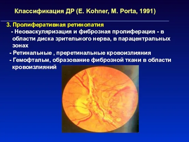 Классификация ДР (E. Kohner, M. Porta, 1991) 3. Пролиферативная ретинопатия