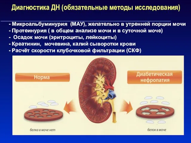 Диагностика ДН (обязательные методы исследования) - Микроальбуминурия (МАУ), желательно в