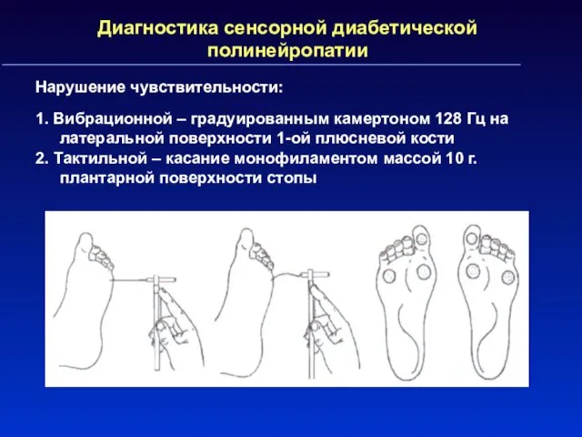 Диагностика сенсорной диабетической полинейропатии Нарушение чувствительности: 1. Вибрационной – градуированным