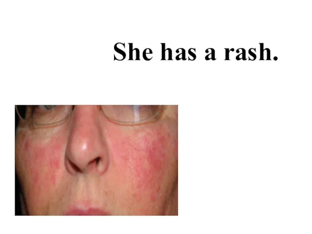 She has a rash.