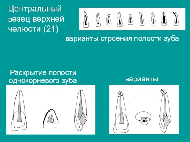 Центральный резец верхней челюсти (21) варианты строения полости зуба Раскрытие полости однокорневого зуба варианты