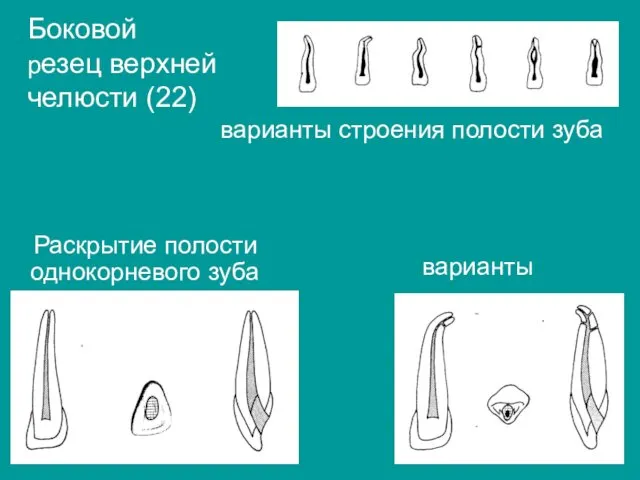 Боковой резец верхней челюсти (22) варианты строения полости зуба Раскрытие полости однокорневого зуба варианты