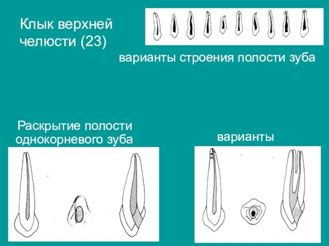 Раскрытие полости однокорневого зуба варианты Клык верхней челюсти (23) варианты строения полости зуба