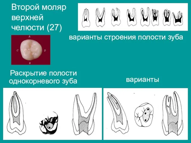 варианты Второй моляр верхней челюсти (27) варианты строения полости зуба Раскрытие полости однокорневого зуба