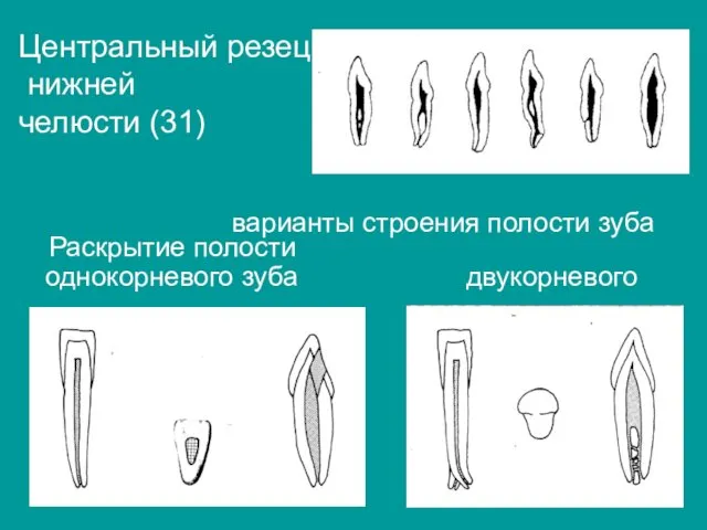 Раскрытие полости однокорневого зуба двукорневого Центральный резец нижней челюсти (31) варианты строения полости зуба