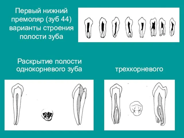 Первый нижний премоляр (зуб 44) варианты строения полости зуба Раскрытие полости однокорневого зуба трехкорневого