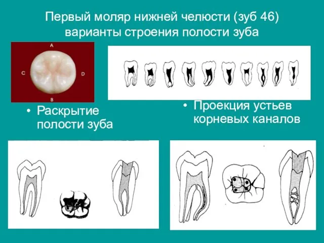 Первый моляр нижней челюсти (зуб 46) варианты строения полости зуба