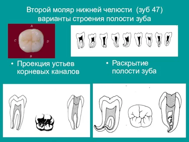 Второй моляр нижней челюсти (зуб 47) варианты строения полости зуба