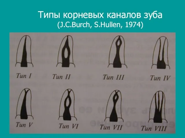 Типы корневых каналов зуба (J.C.Burch, S.Hullen, 1974)