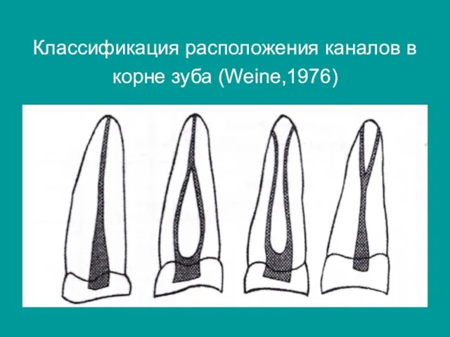 Классификация расположения каналов в корне зуба (Weine,1976)